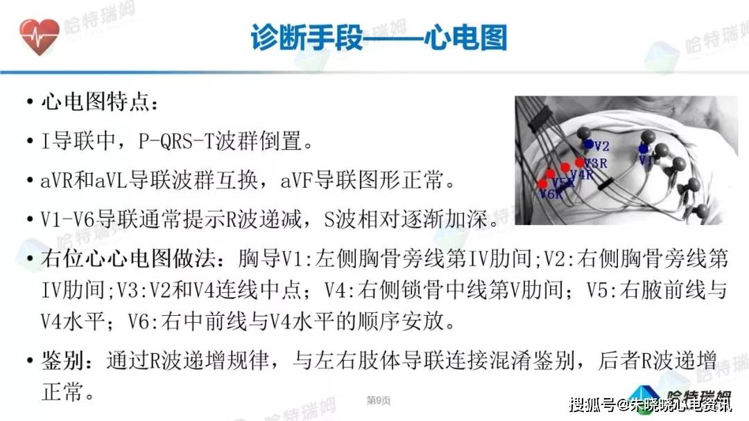 镜面右位心