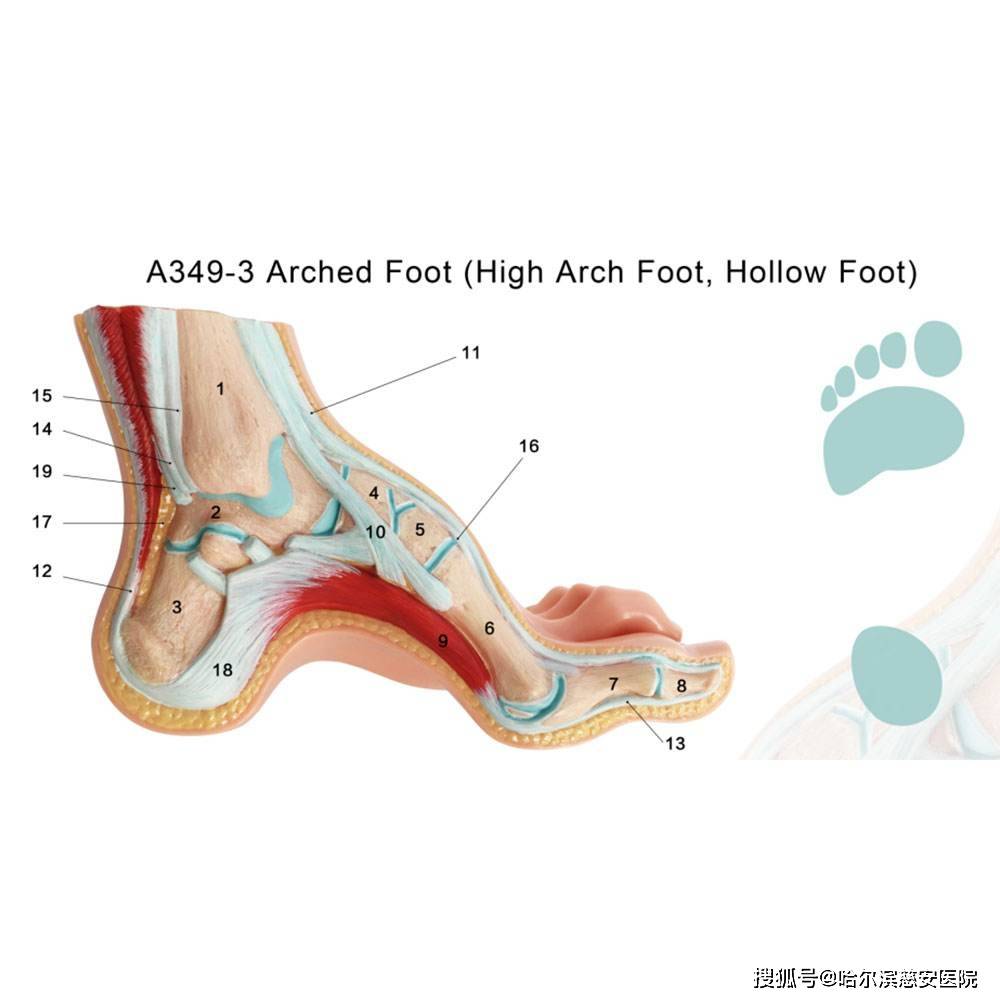 【科普】先天性高弓足