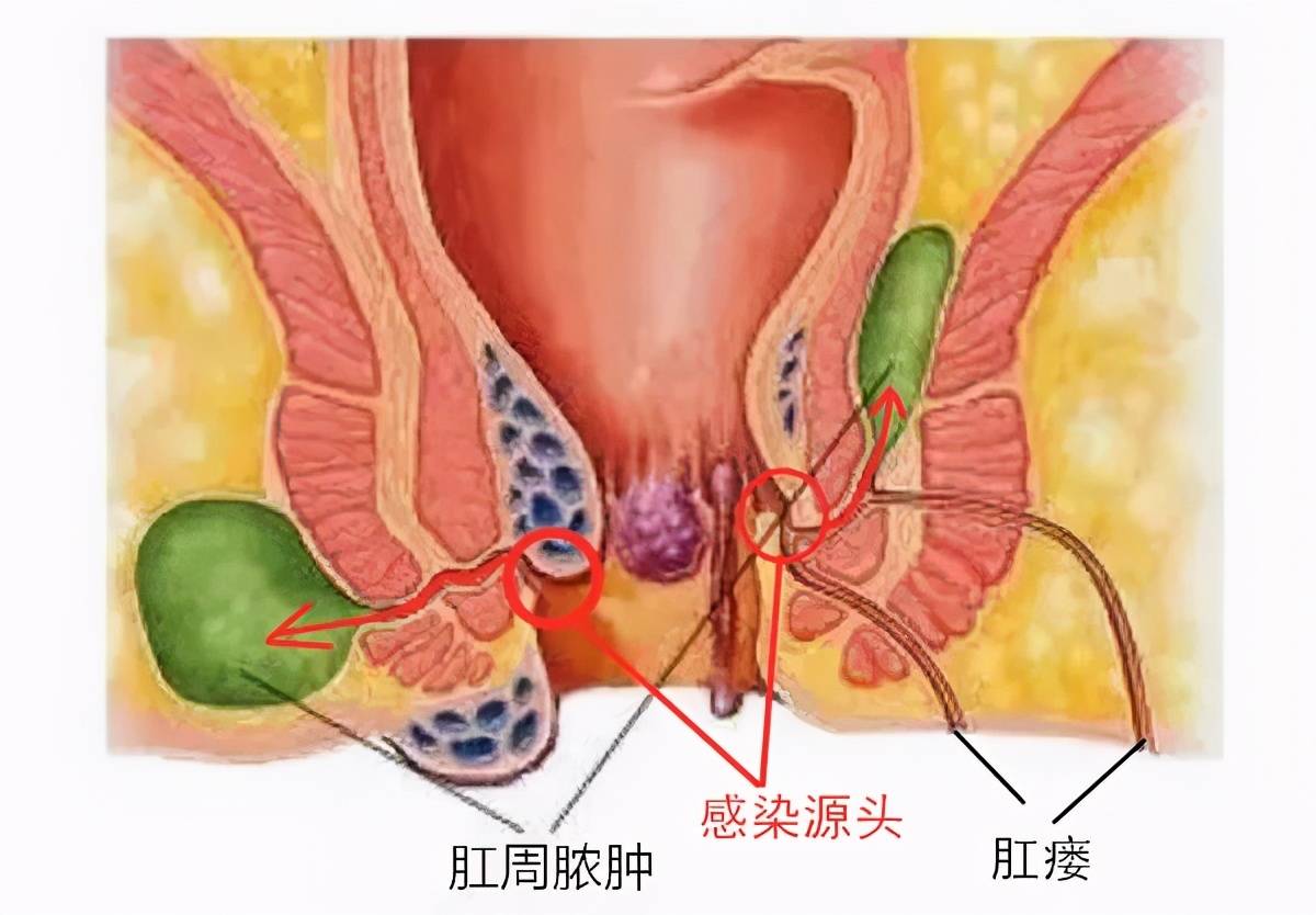 来自肛周脓肿的真情自白