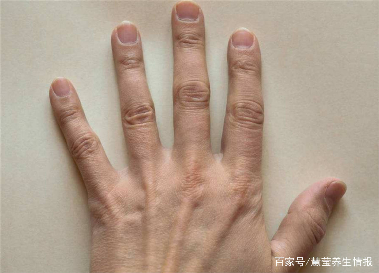 第二,出现肝掌