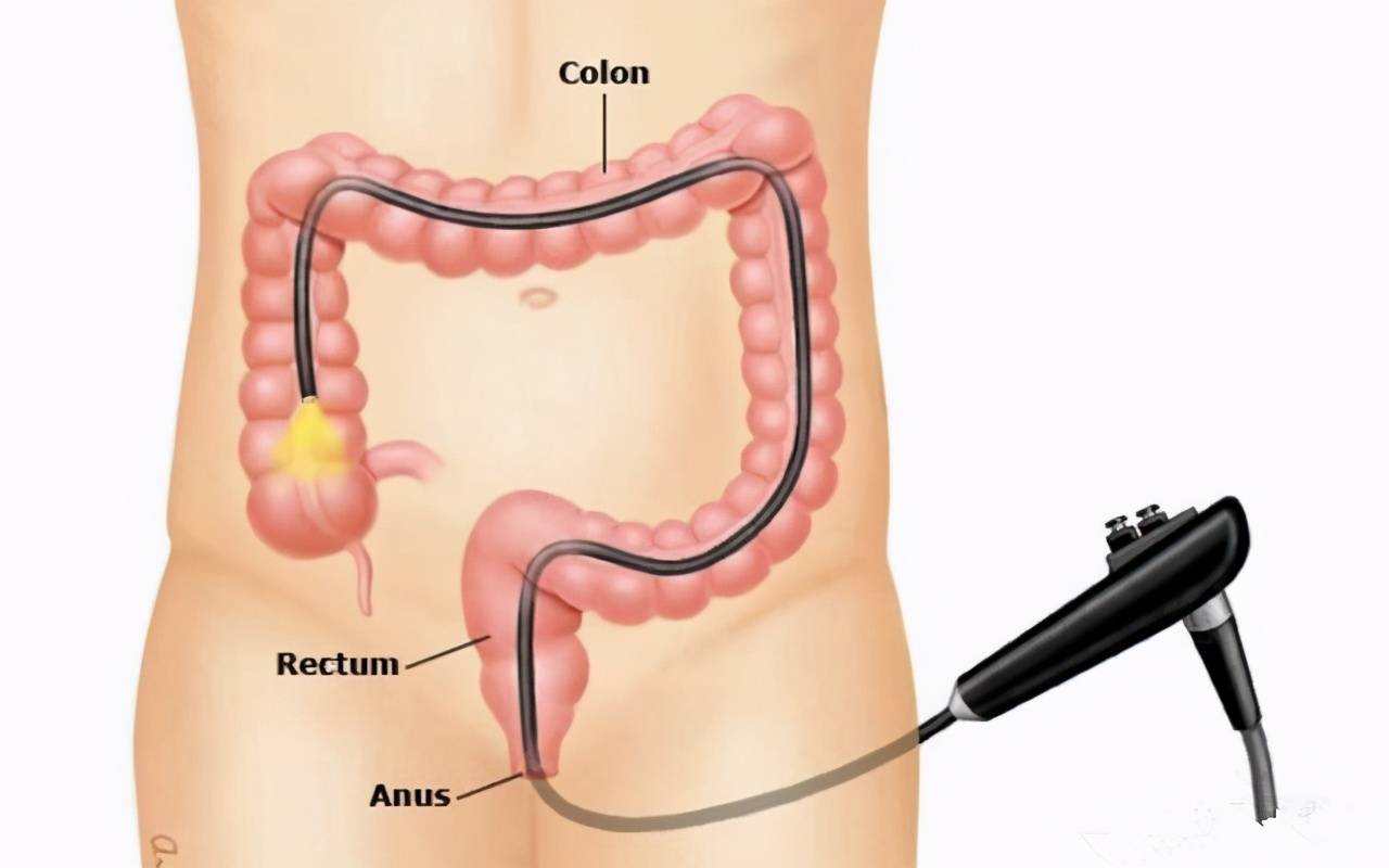 癌症怎么检查是第几期 2ec8f2226dd1484d9b7324a69c65607e.jpeg