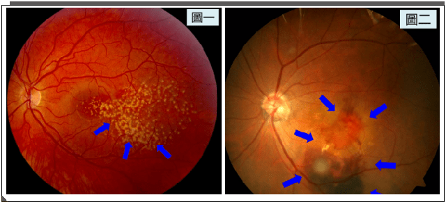黄斑病变,哪些可以用药物治?哪些必须手术?