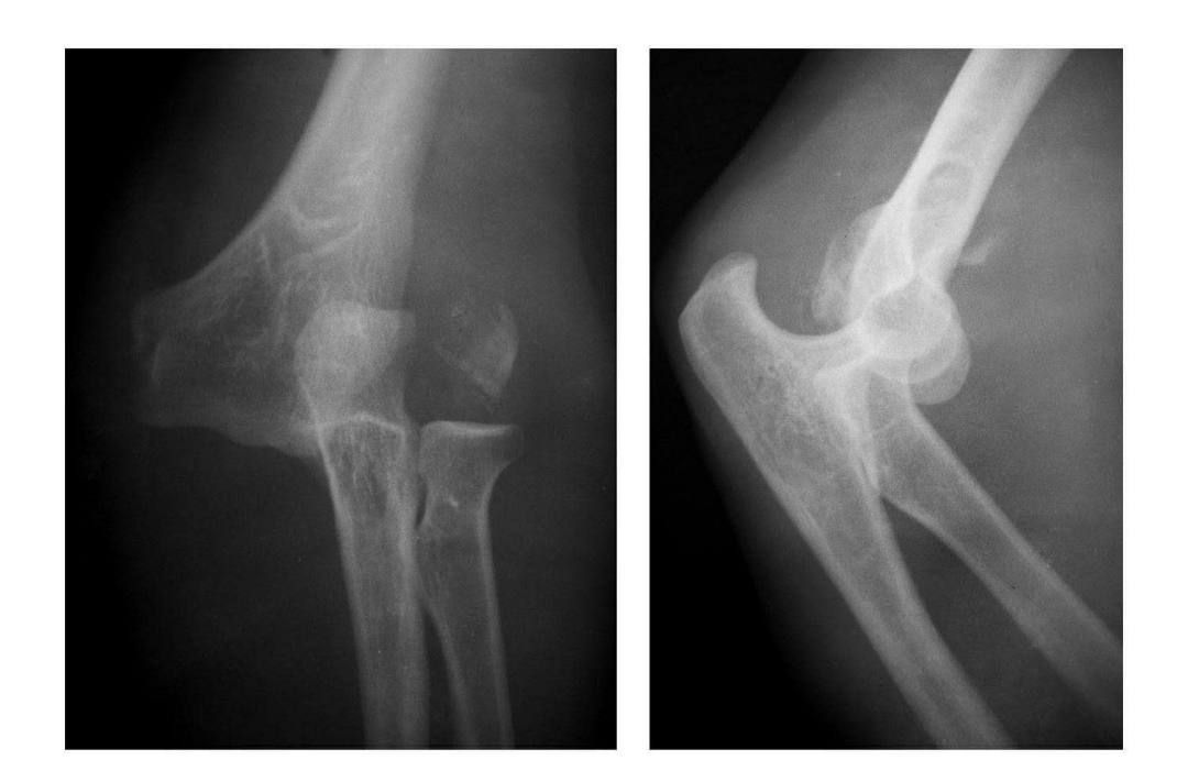 例6:肘关节后外侧脱位合并外髁劈裂骨折.