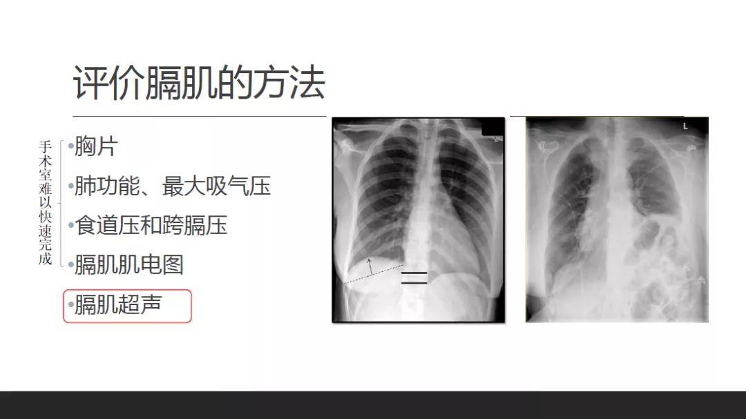 膈肌是重要呼吸肌,通常可以通过胸片,ct,超声,跨膈压和肺功能等方法