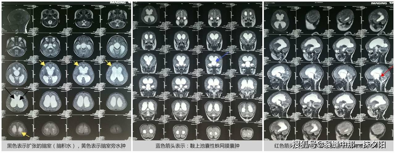 两岁患儿的鞍上池蛛网膜囊肿伴脑积水案例