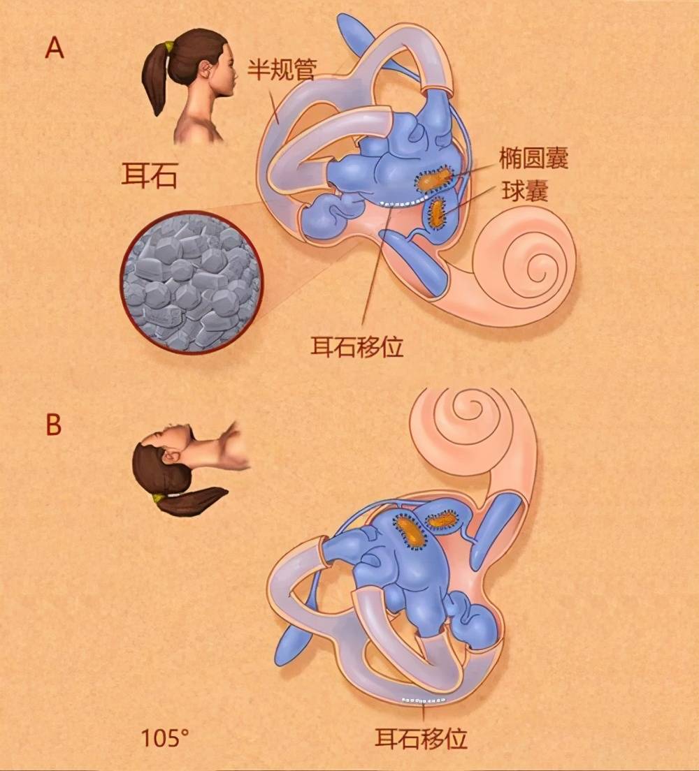耳石应该在内耳的椭圆囊里,如果,耳石移位到半规管里,人就不平衡了