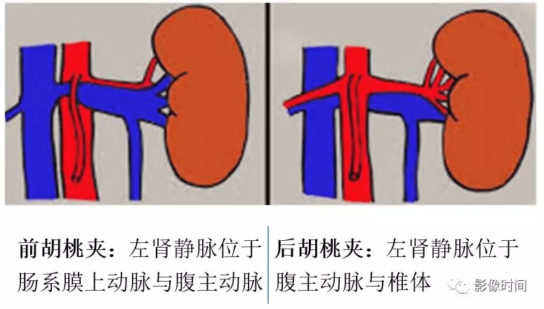 5 种腹部血管压迫综合征,看了就不会忘记_静脉