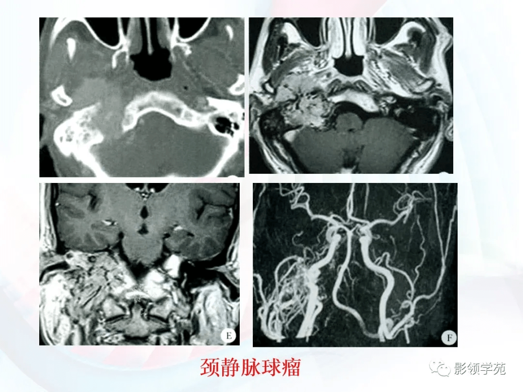 differential diagnosis颈静脉球假瘤颈静脉孔区脑膜瘤神经鞘瘤后颅窝