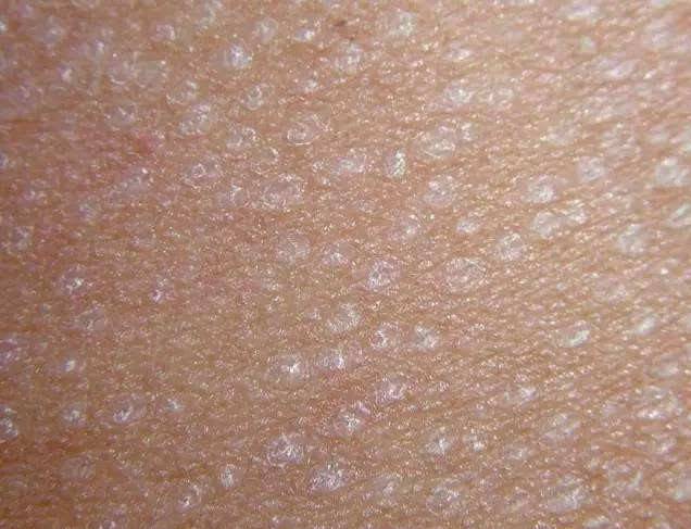 皮肤被真菌感染出现问题怎么办?