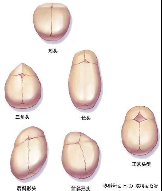 九院韦敏教授丨什么是颅缝早闭危害有多大