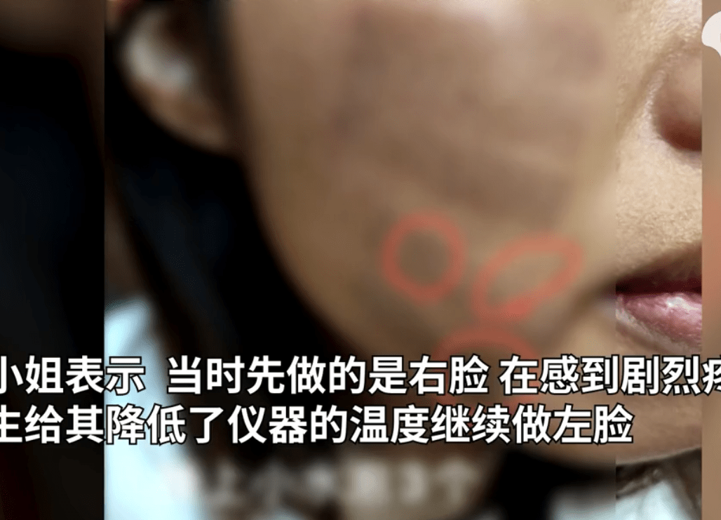 广东女子做光子嫩肤,脸被烫出5道杠,美容医院拒绝赔偿