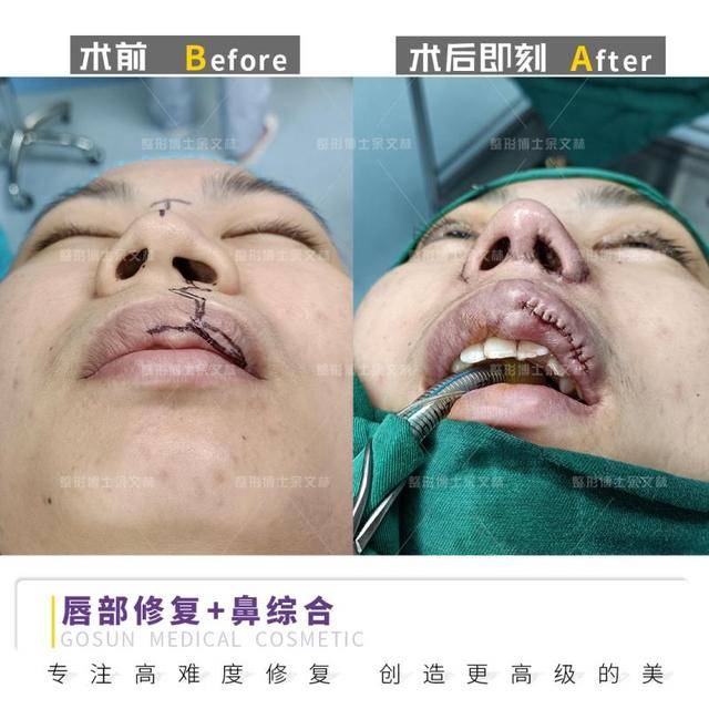 唇裂术后鼻修复,这种材料超适合?