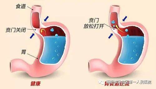 喝什么茶对胃食管反流好 759ffe0119aa4b6fad54fac58ff116a3.jpeg
