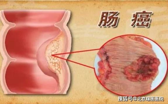 肠息肉开始癌变,大便会有四个标志