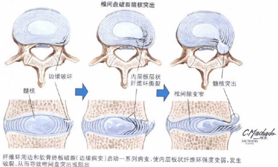 很多研究都表明, 腰椎间盘突出患者的腰骶部疼痛越重要,生理曲度改变