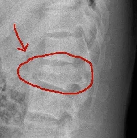 图为患者摔伤后x线片显示腰椎骨折处