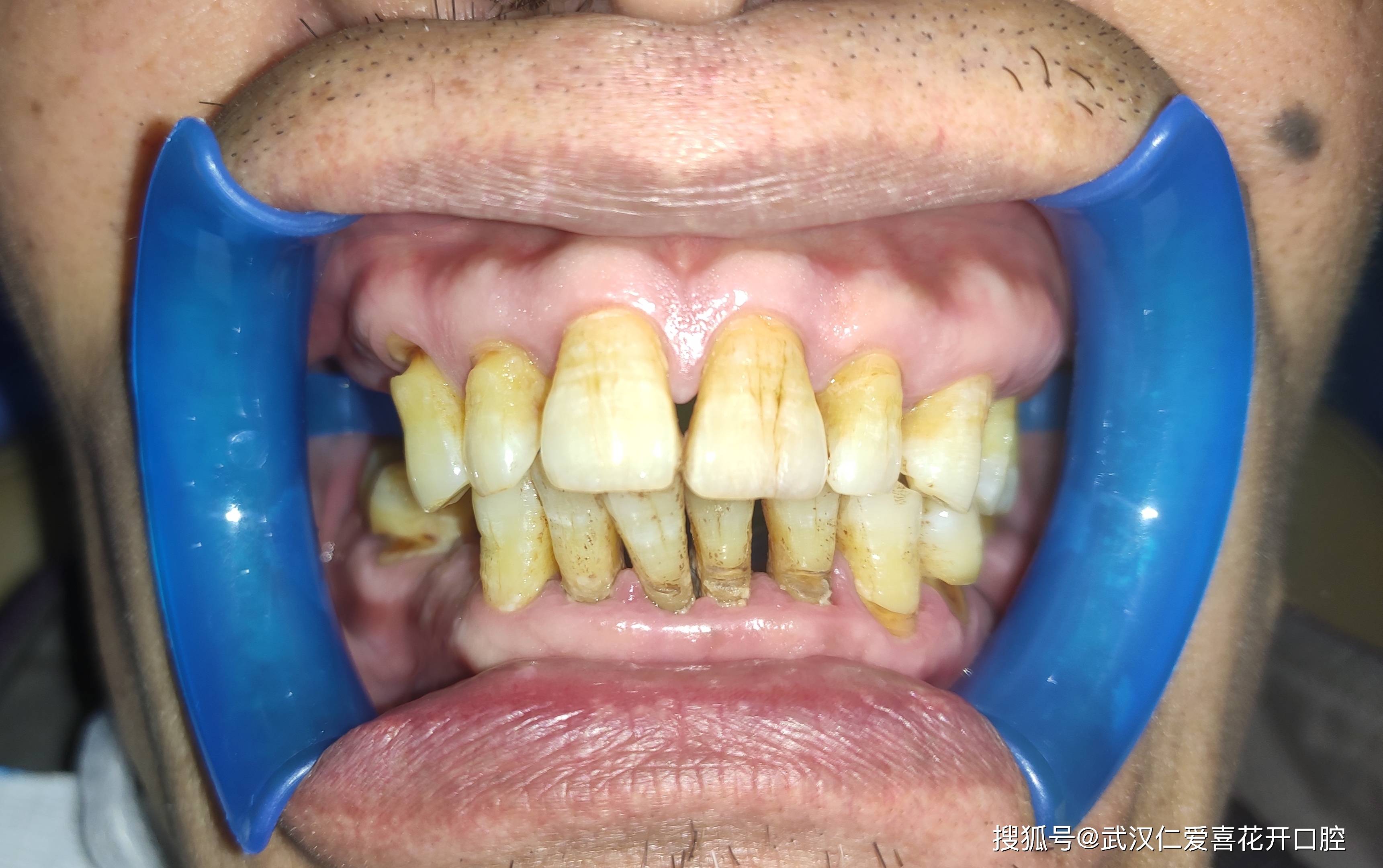 中期牙周炎:牙周袋会进一步加深,牙齿有松动,移位的症状.