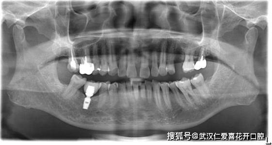 小小"牙尖",所引起的后果!不知道你有没?_牙齿