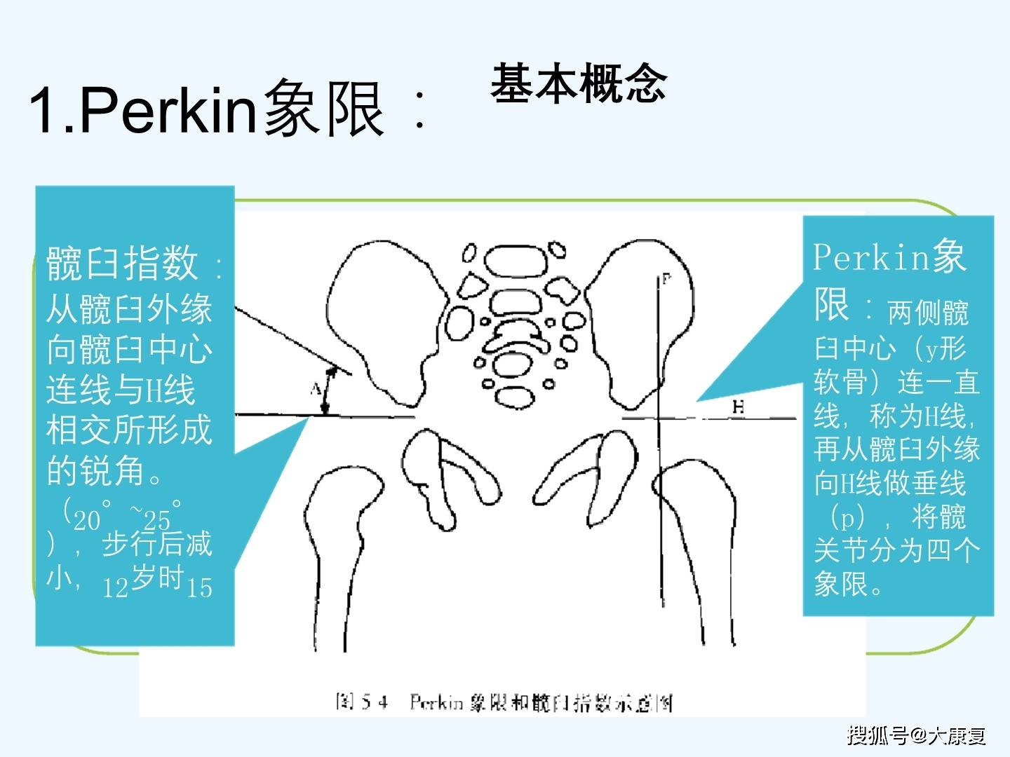 发育性髋关节脱位