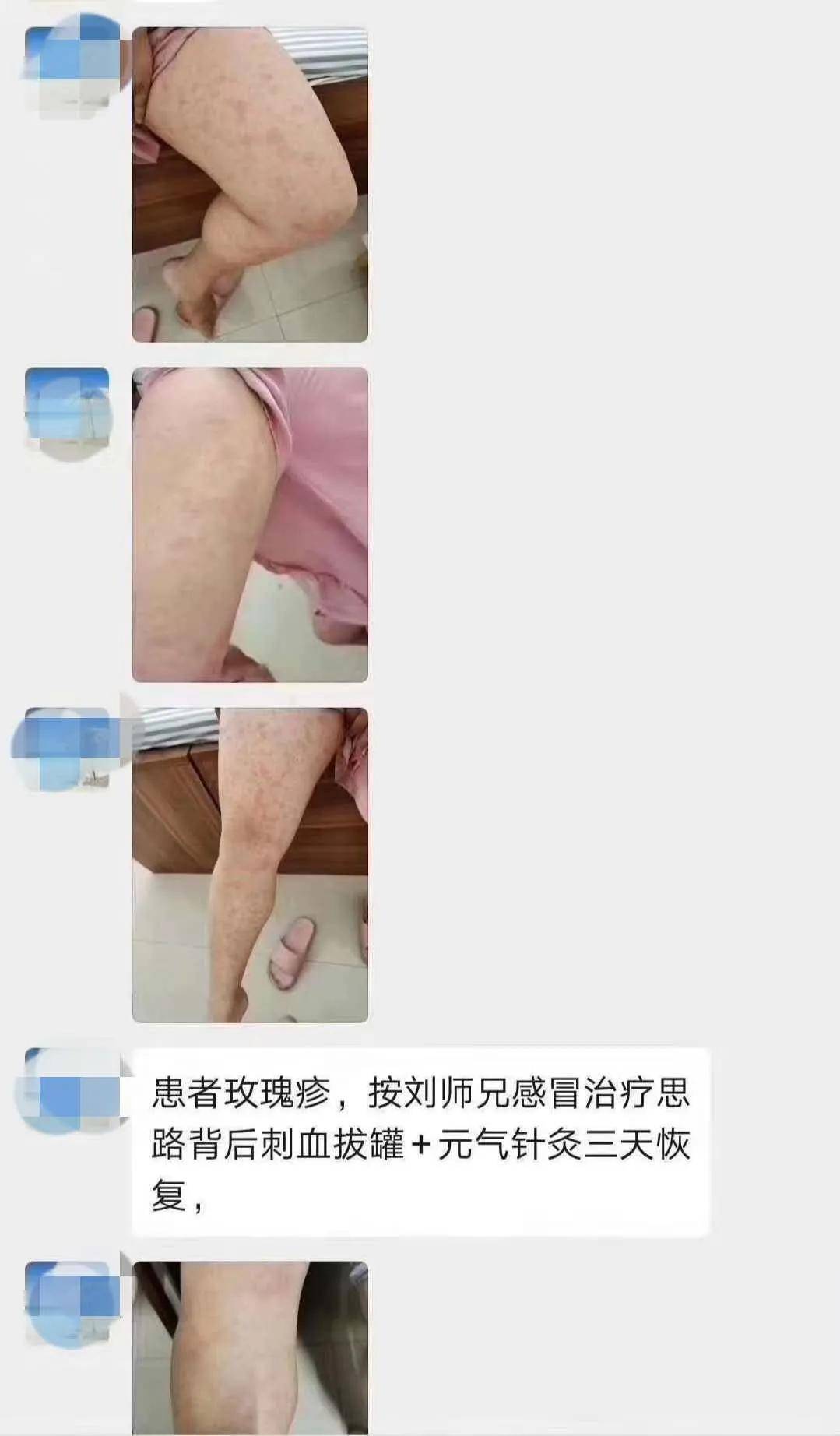 师友反馈:患者玫瑰疹,元气针灸3次治愈!