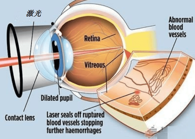 激光视网膜手术 52deb9aea8074d888891476267a0d6f2.png