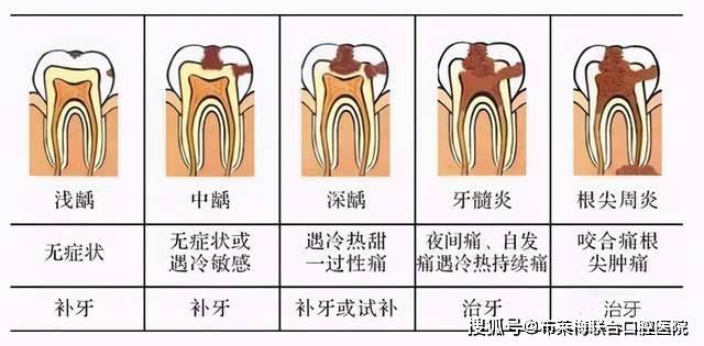 浅龋仅发生在牙釉质内,呈黑点或者白垩色的改变,没有明显的龋洞,平时