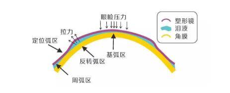 长期戴ok镜,角膜会变薄吗?