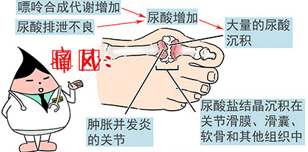 痛风石是由于尿酸盐溶解度低,容易在皮下析出晶体而形成的.