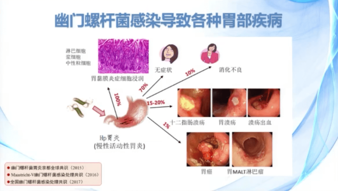 医学界最新研究幽门螺杆菌根治方案有变化快看