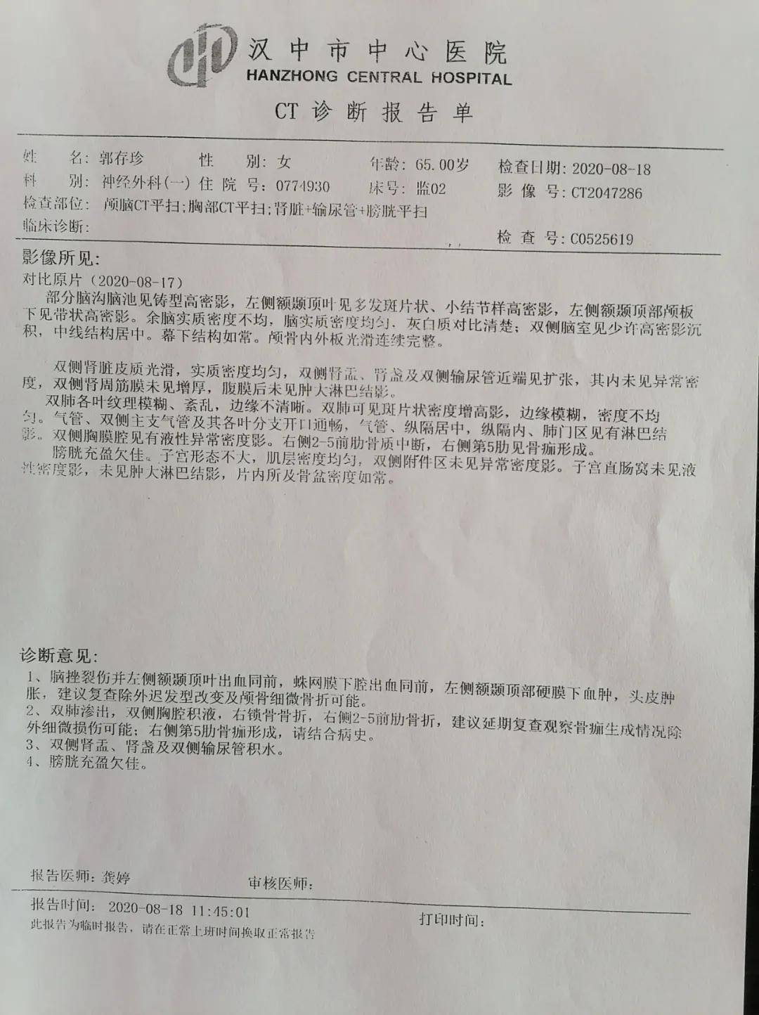 5,右侧锁骨粉碎性骨折,中段骨折,右侧5批肋骨骨折.