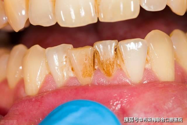 怎样正确刷牙防止口臭 67e95fb1b7004db5bfe2d75036460cf3.jpeg