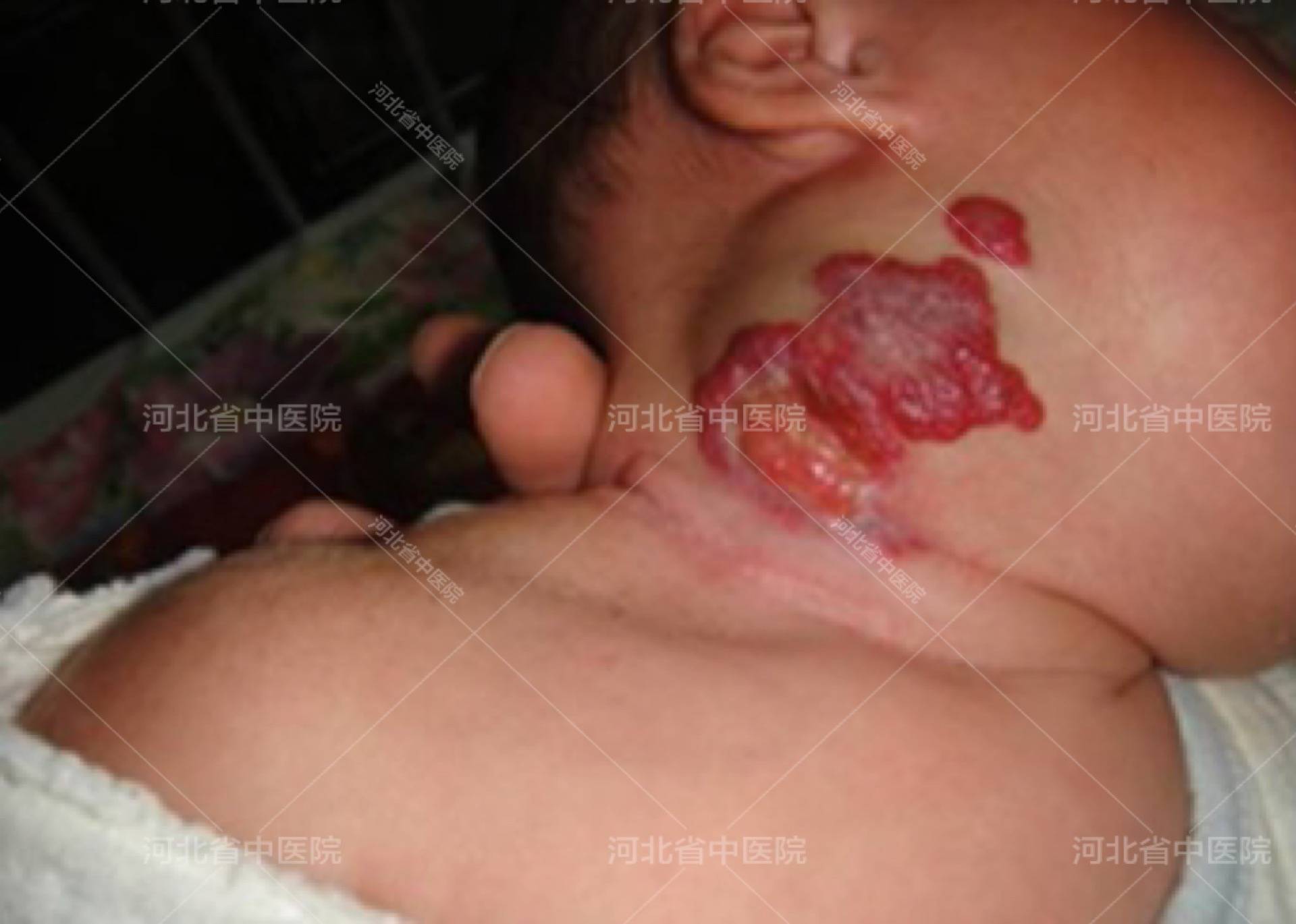 
河北省中医院医疗美容科：家长如何分辨婴幼儿血管瘤？【PG电子注册】