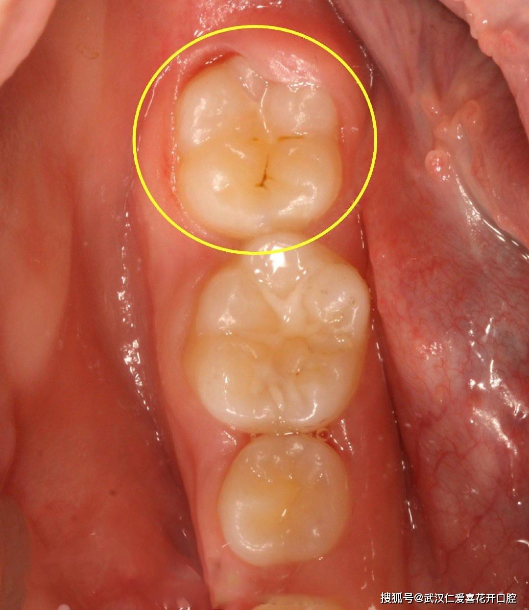 如果你的蛀牙到这种程度了,就不能靠补牙拯救了!