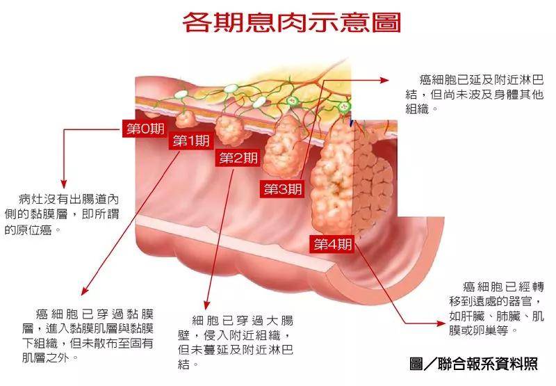 发现大肠息肉,切除后还需要做什么?