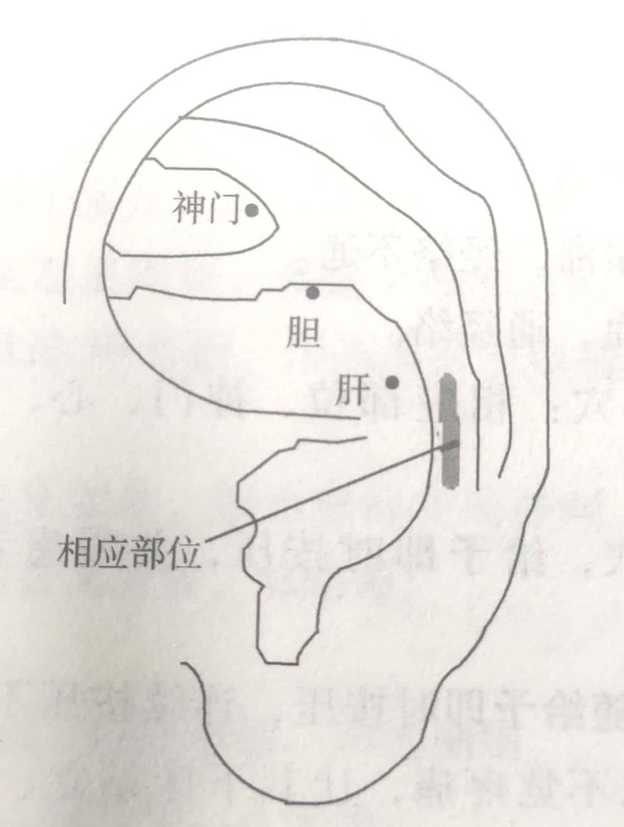 【治疗 取耳穴:胆,肝,神门,相应部位(如图.