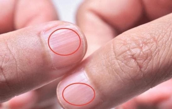 肝毒增多,手指先知?观察指甲的3个"异常",注意防范