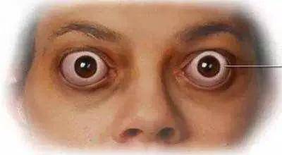 甲亢的病情较重者眼球突出程度不均衡, 发生甲亢性突眼几率较大