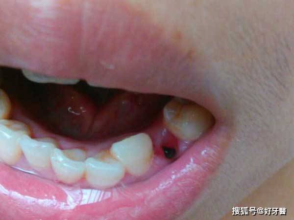 血块脱落之后,牙槽骨直接暴露于口腔环境,愈合过程受到影响;患者拔牙