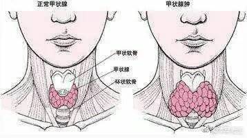 南昌博大甲状腺:甲状腺检出结节了,需要看医生吗?