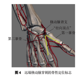 经远端桡动脉行冠状动脉介入诊疗中国专家共识