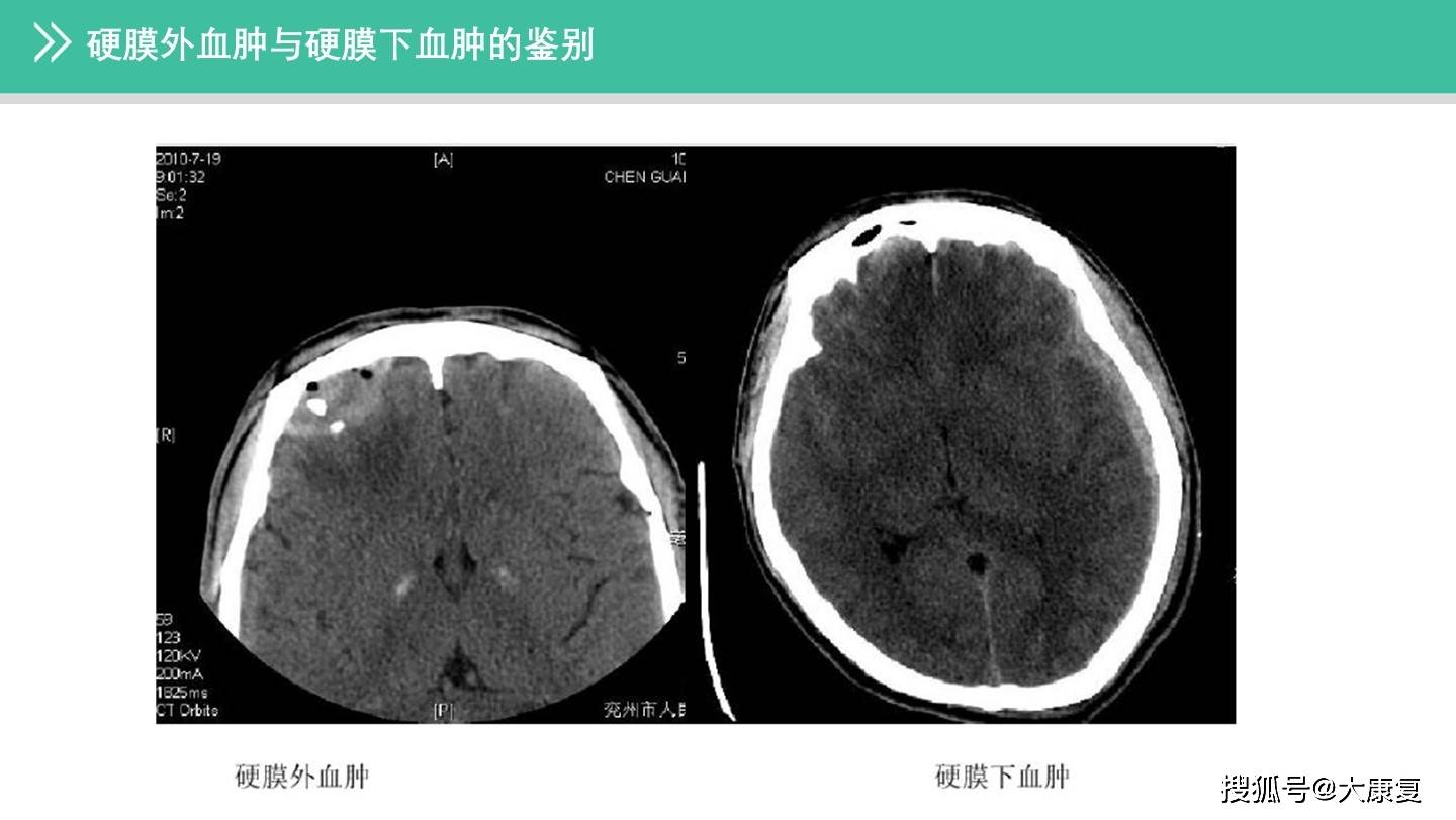 硬膜外血肿与硬膜下血肿的鉴别]