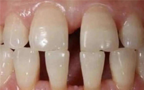树脂修复 对于 1 ~ 2 mm 的门牙牙缝,可以直接用树脂美学修复,只是