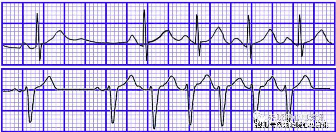 房性心动过速的心电图诊断与鉴别