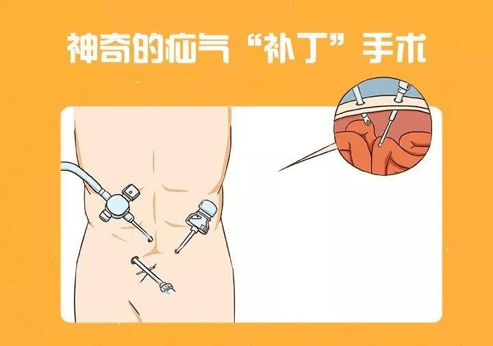 名医专访丨大连医科大学附属第一医院董擂:疝气那些事