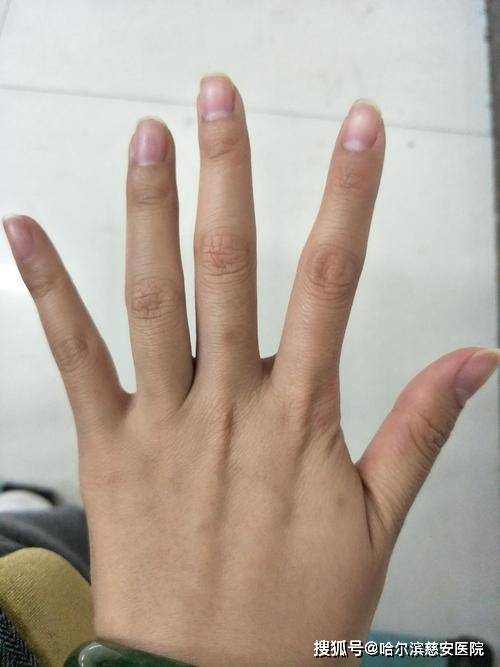 手指发黑发紫严重吗