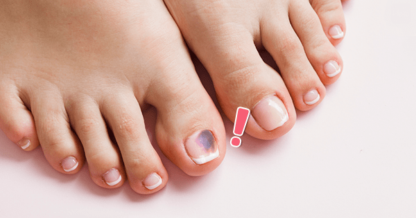 而香港脚,灰指甲就是其中最难治疗的霉菌病之一,灰指甲更是超级容易被