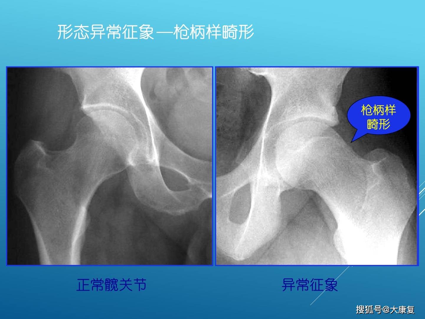 股髋关节撞击综合症