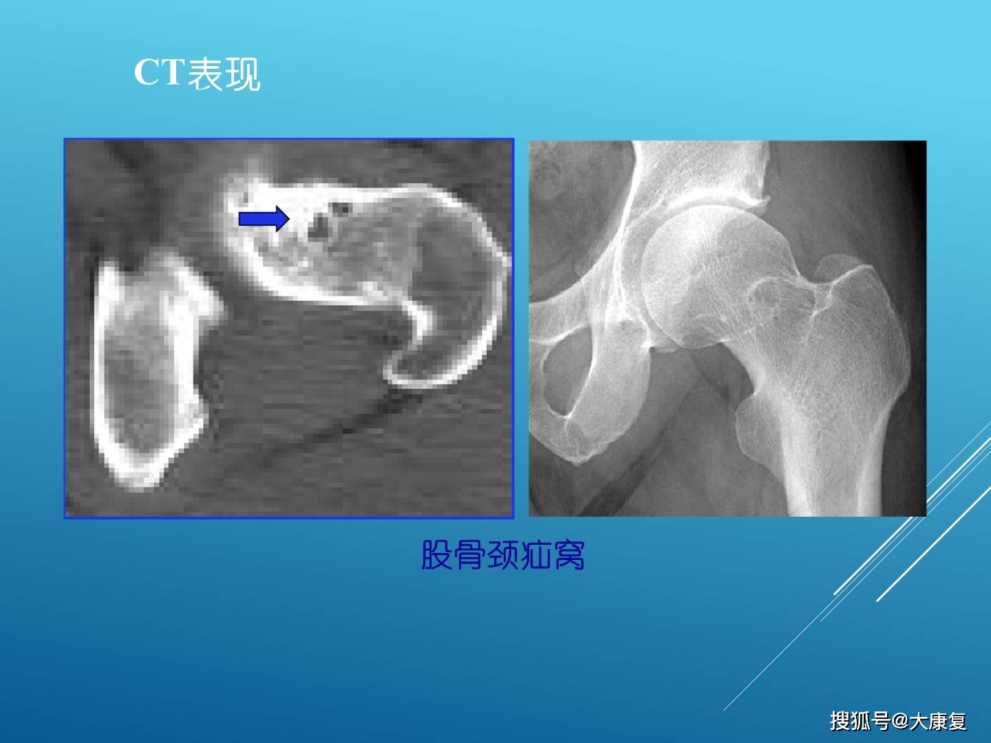 股髋关节撞击综合症