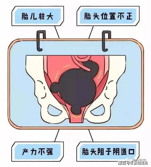 侧切或撕裂,真的是顺产的"标配"吗?