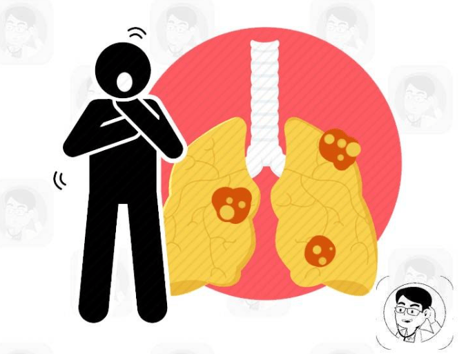 肺癌是拖出来的,医生提醒:身体若有4个异常,需尽快就医检查!